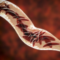 Sickle Cell Disease: Understanding Symptoms, Heredity, and Genetics