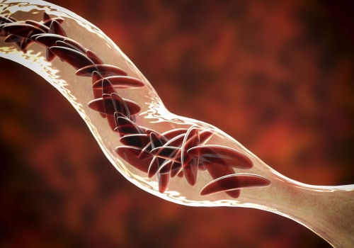 Sickle Cell Disease: Understanding Symptoms, Heredity, and Genetics